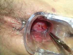 Mirena Spirale rimozione ziehen IUD IUP entfernen
